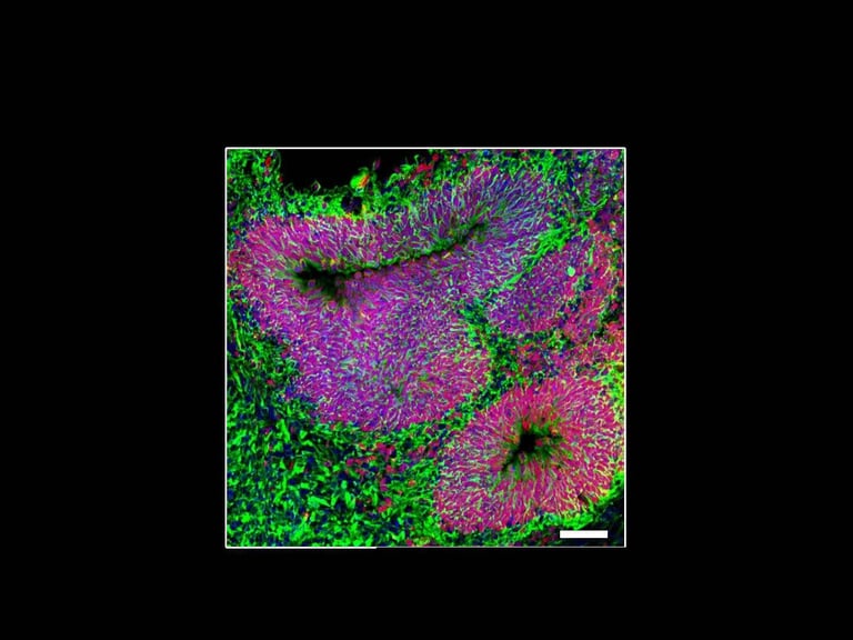 Revolutionary Tool Uses Lipid Nanoparticles to Edit Genes in Fetal Brain, Offering Hope for Autism and Neurodevelopmental Disorders