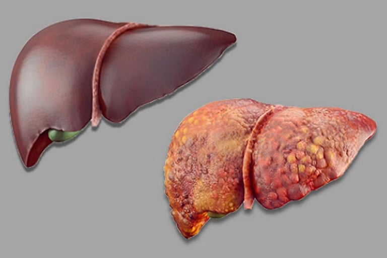 Study: Inulin Fiber May Combat Fatty Liver Disease and Insulin Resistance