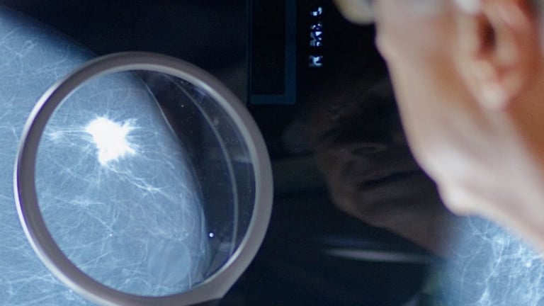 Mia AI Outperforms Radiologists in NHS Breast Cancer Trial, Eyes Nationwide Rollout
