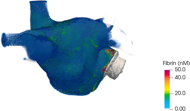 3D Models Revolutionize Heart Procedure, Tailoring Treatment for Atrial Fibrillation Patients