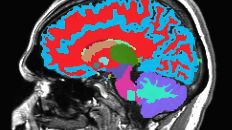 Revolutionary MRI Tool Predicts Aging Speed, Disease Risks Years in Advance