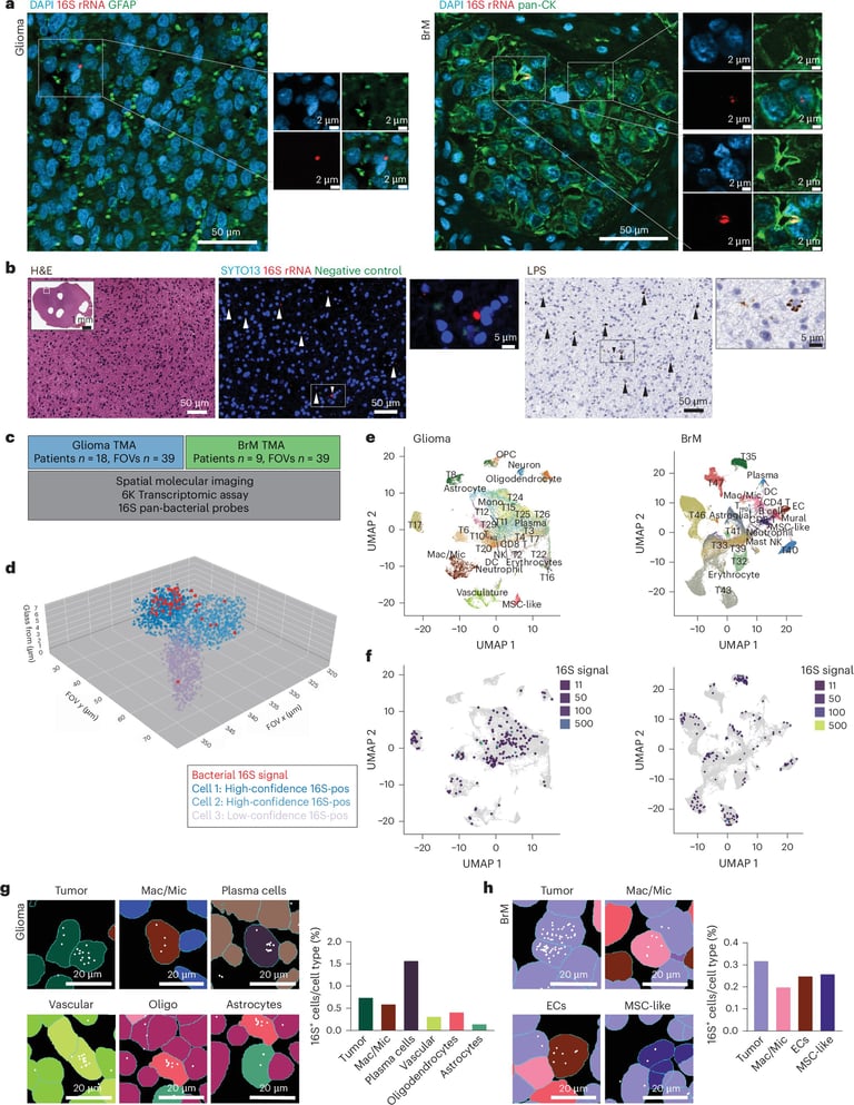 Bacteria Found in Brain Tumors Could Impact Cancer Growth and Treatment, Study Reveals