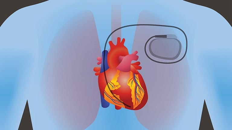 Project My Heart Your Heart: Recycled Pacemakers Save Lives in Impoverished Regions