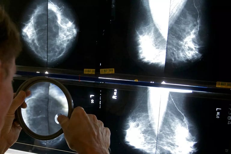 Boosting Breast Cancer Screening Could Save Lives and Millions for NHS, Report Reveals