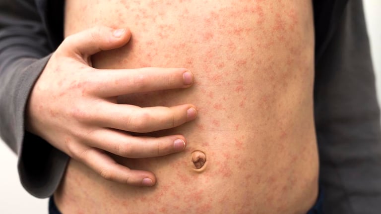 Measles Alert in Western Australia: Health Officials Urge Vaccination Amid Rising Cases and Exposure Sites