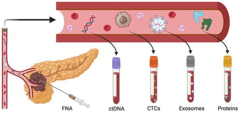 Breakthrough Liquid Biopsy Techniques Hold Promise for Early Pancreatic Cancer Detection