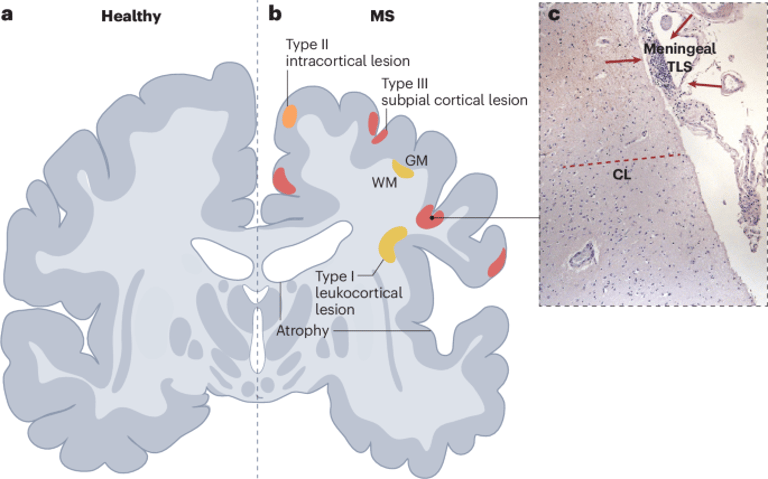 Cortical Involvement in MS: New Insights into Early Pathology and Treatment Strategies