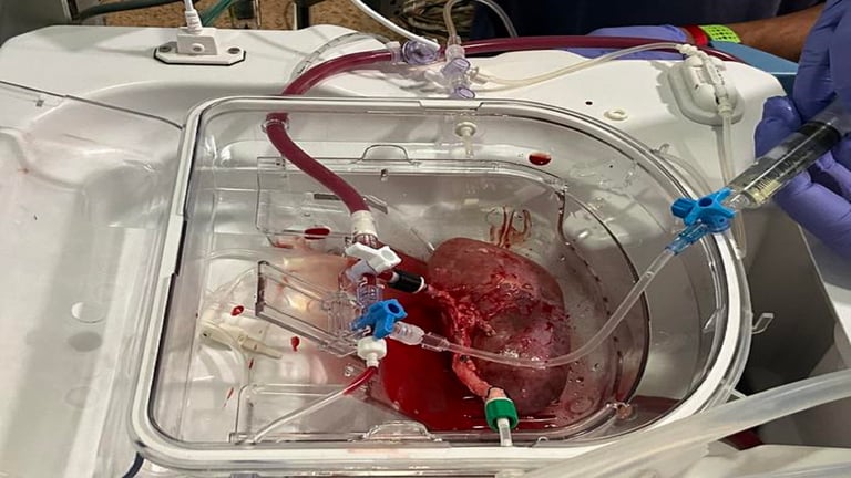 Breakthrough Study: Human Kidney Organoids Thrive in Pig Kidneys, Paving Way for Organ Regeneration