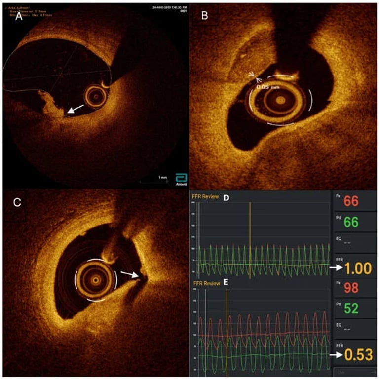 OCT Enhances Stent Decisions in Multivessel Coronary Disease, Study Shows