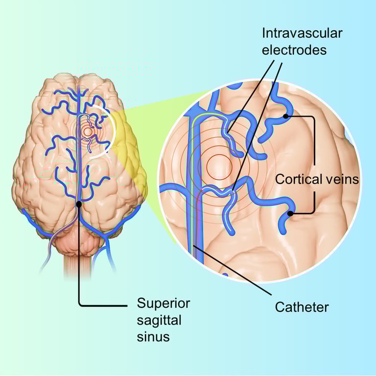 Revolutionary Brain Monitoring Technique Uses Ultra-Thin Electrodes for Non-Invasive Access to Deep Brain Regions