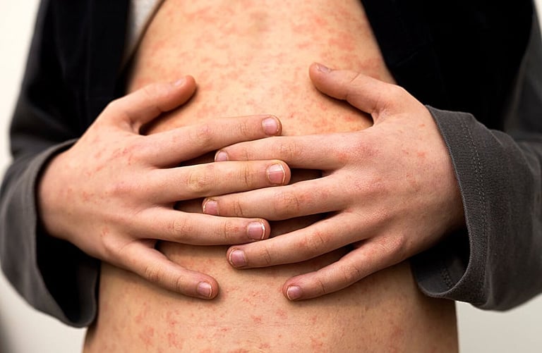 U.S. Measles Surge: Declining Vaccination Rates Trigger Highest Case Count Since 2019
