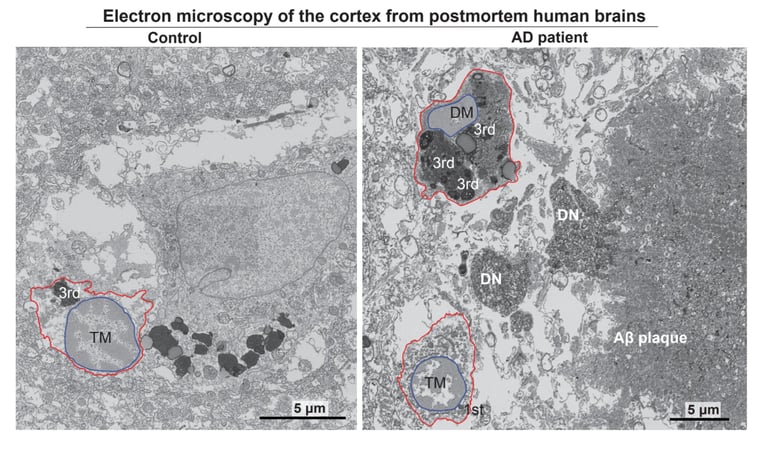 Breakthrough Alzheimer's Study Reveals Key Role of Microglial Cells in Disease Progression