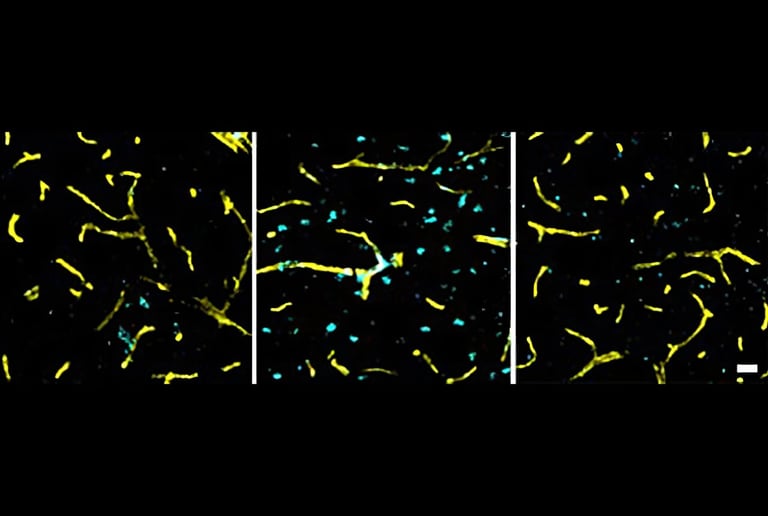 Early Brain Changes Linked to Hypertension Identified, Offering New Insight into Cognitive Decline