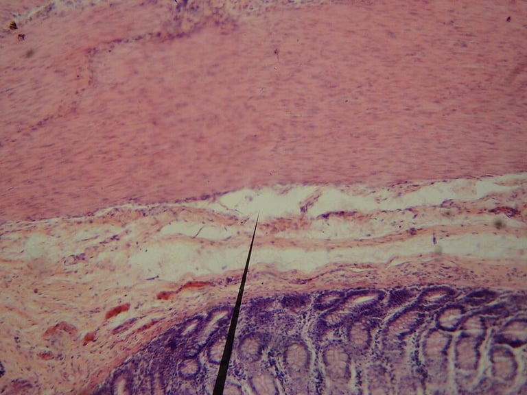 Gut Fungus Fusarium Foetens: A New Hope for Fatty Liver Disease Treatment