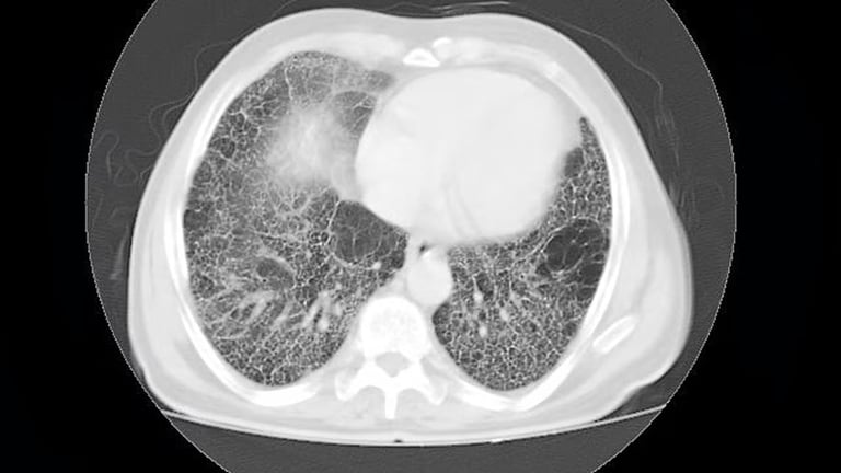 Nerandomilast Trial Shows Promising Results in Slowing Pulmonary Fibrosis Decline