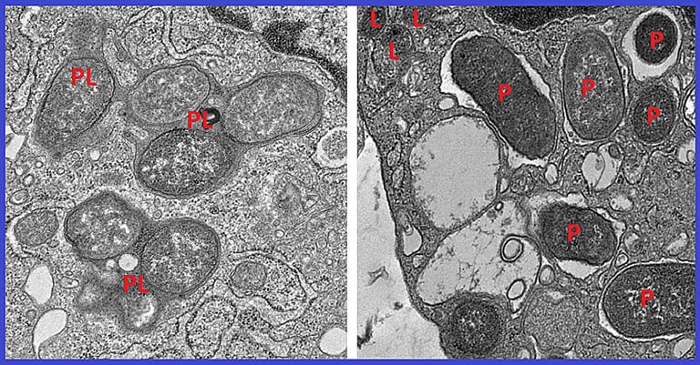 Breakthrough Study Reveals How NOD2 Mutation Fuels Crohn's Disease, Paving Way for New Treatments