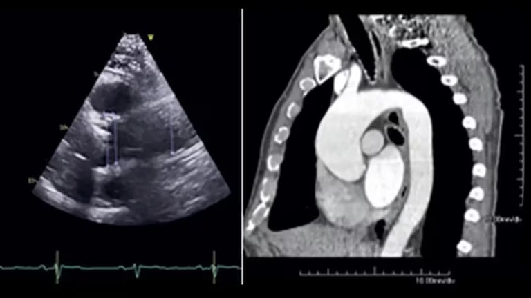 Refined Aortic Surgery Timing: Height-Indexed Metrics and CE-CTA Enhance Risk Assessment