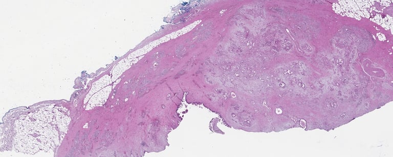 Revolutionary Glycan Blood Test Promises Early Detection of Pancreatic Cancer