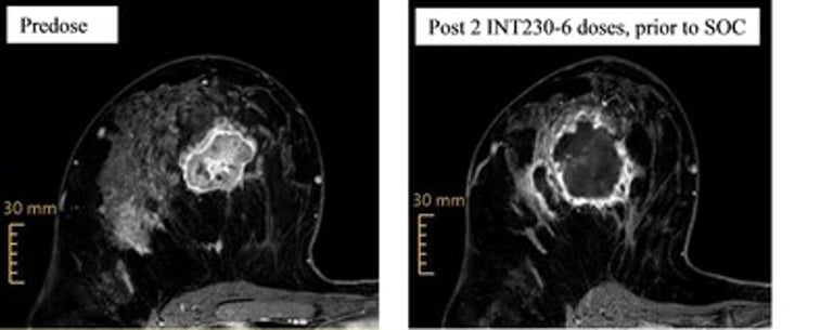 Promising Early Results for INT230-6 in Triple-Negative Breast Cancer Trial