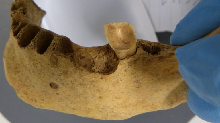 Sweet Decay: Study Links Modern Diets to Ancient Oral Health Woes