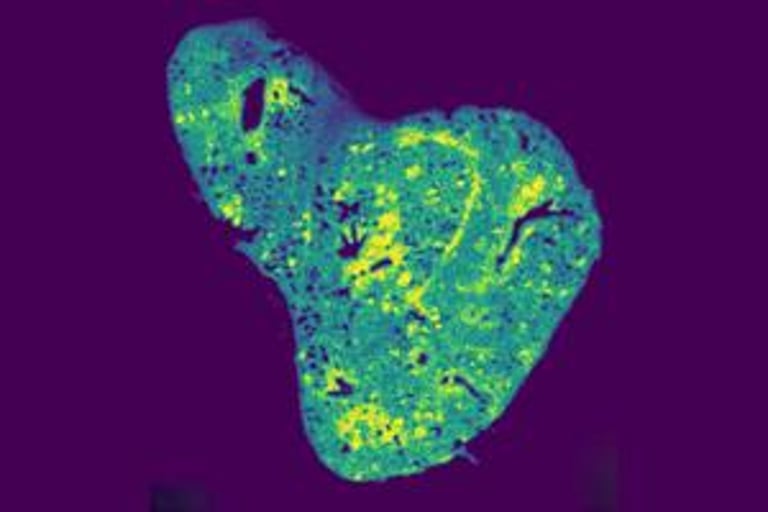 Mitochondrial Glutathione: Key to Halting Breast Cancer Spread with SLC25A39 Inhibition