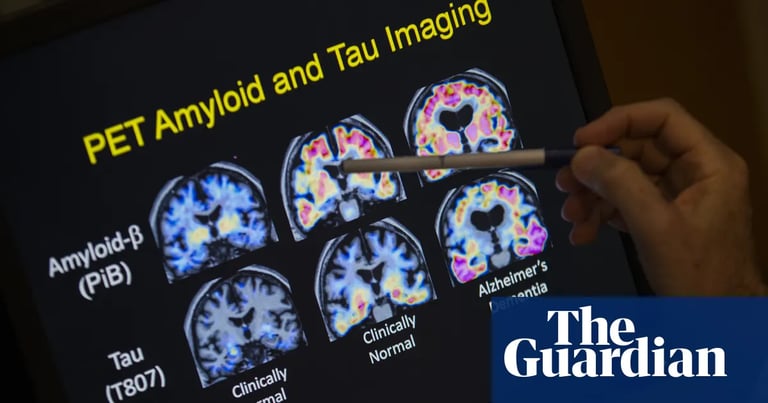 New Genetic Form of Alzheimer's Tied to APOE4 Gene, Study Reveals