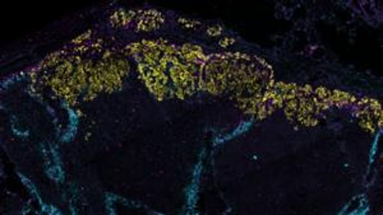 Breast Cancer Discovery: MPG Protein Key to Lymphatic Spread, Offers New Therapy Target