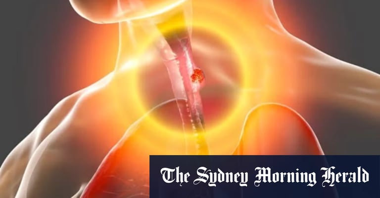 Revolutionary Blood Test PromarkerEso Offers Breakthrough in Early Esophageal Cancer Detection