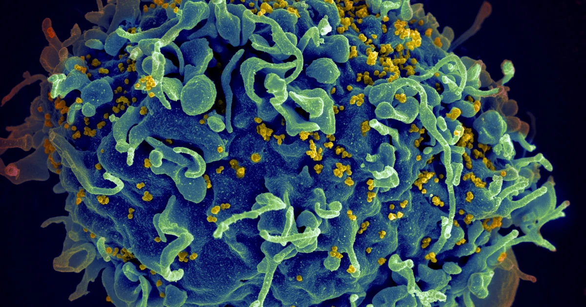 A 7th person with HIV is probably cured after stem cell transplant for leukemia, scientists say