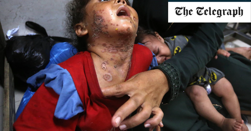 Children disfigured as skin diseases tear through Gaza