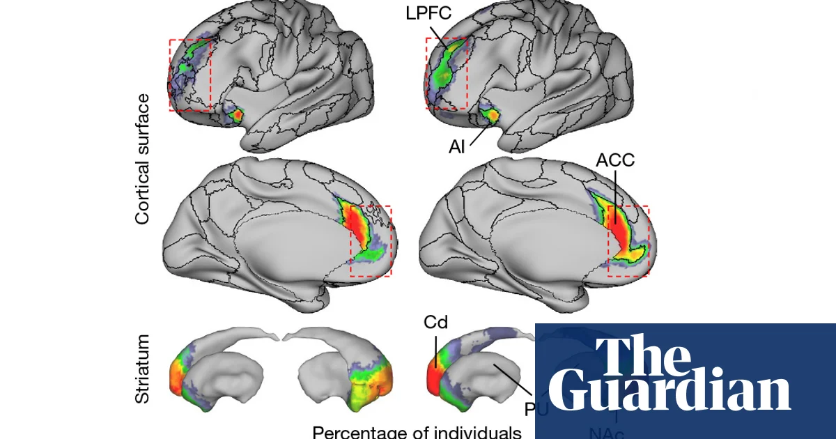 Part of brain network much bigger in people with depression, scientists find