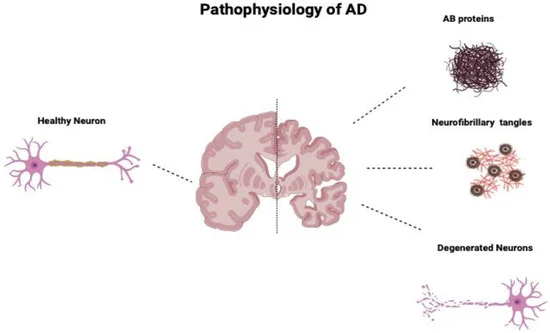 Mesenchymal Stem Cell-Derived Exosomes as a Neuroregeneration Treatment for Alzheimer’s Disease