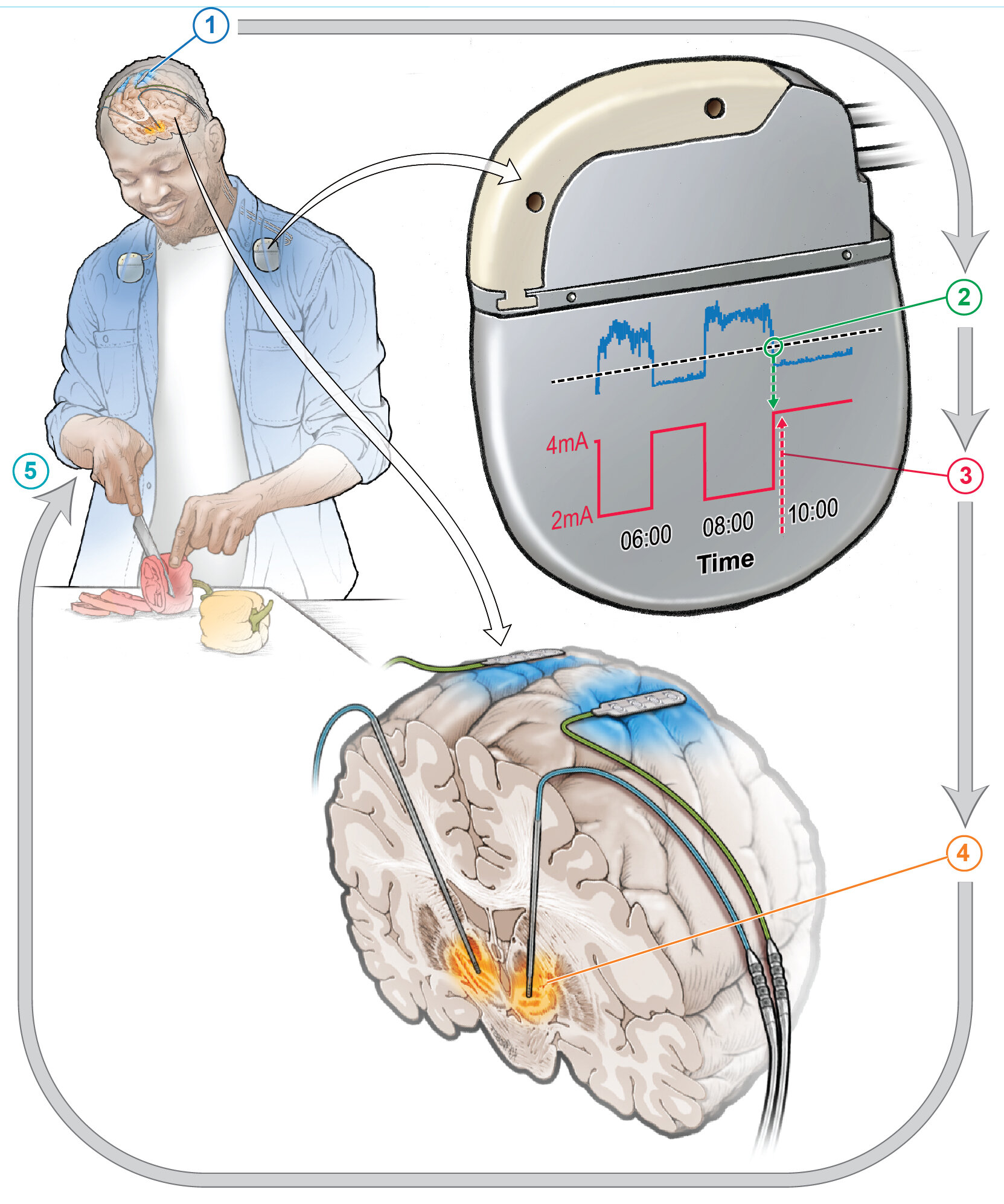 Revolutionary Adaptive Brain Stimulation Halves Parkinson's Symptoms, Promises Personalized Treatment