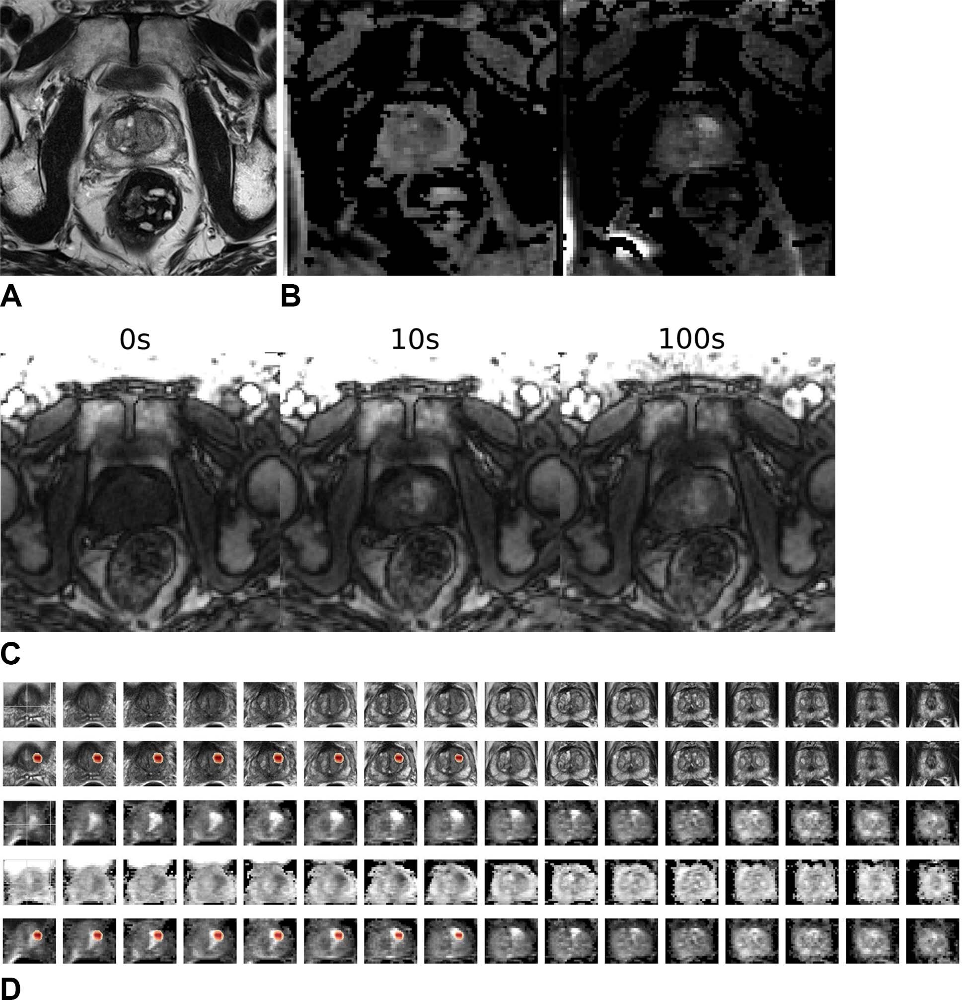 New AI Model Rivals Radiologists in Prostate Cancer Detection, Reduces Unnecessary Biopsies