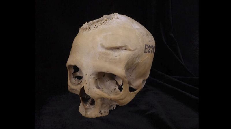 4,000-Year-Old Skull Reveals Ancient Egyptians' Advanced Cancer Surgery