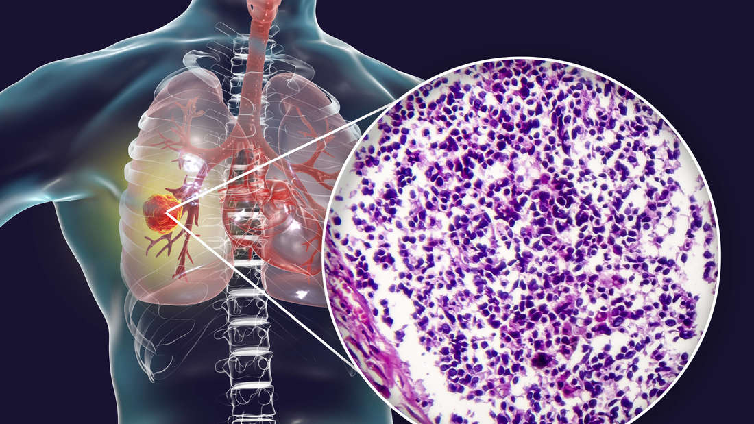 Fingertip Test: Detect Lung Cancer in 5 Seconds with Schamroth Window Method