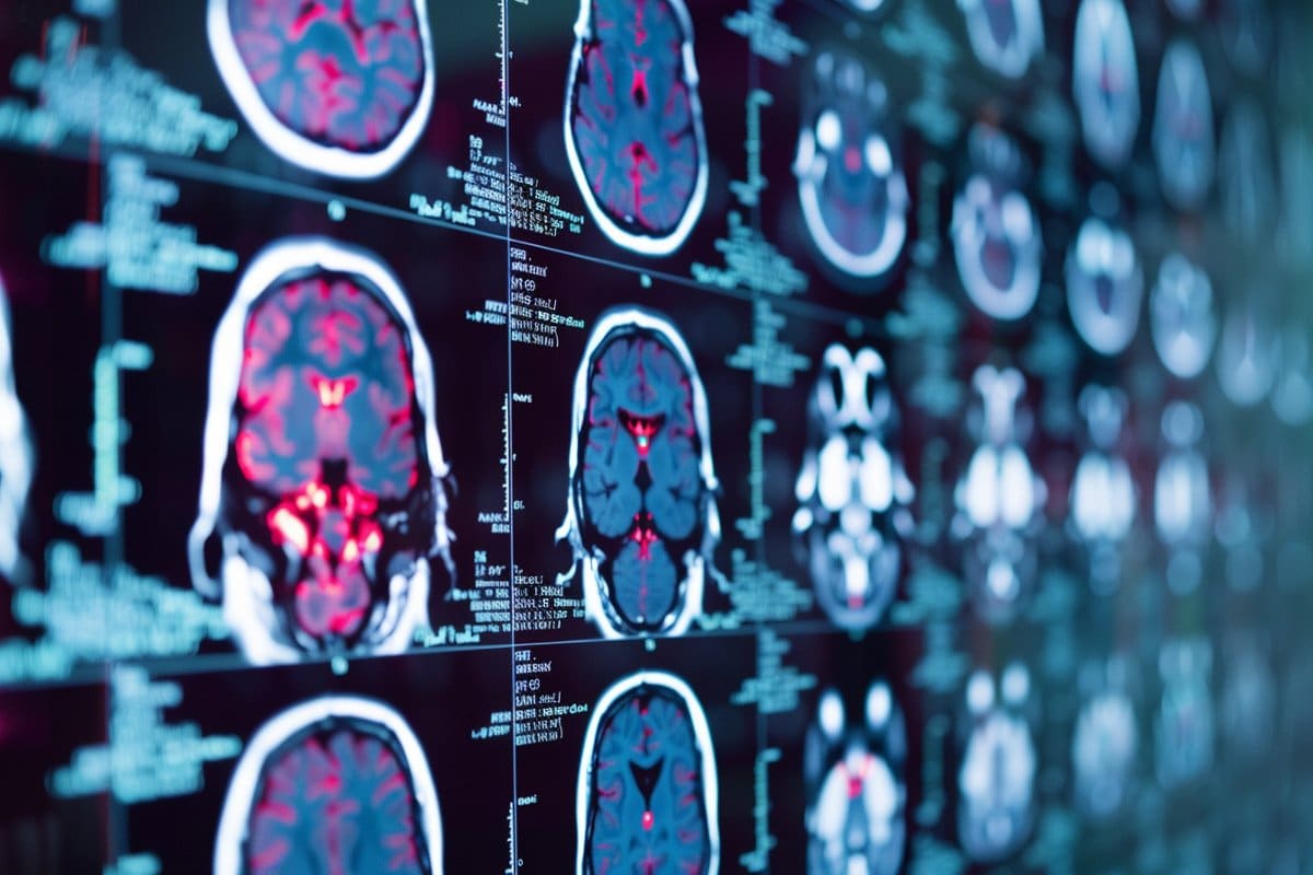 New CAR-T Therapy Shows Rapid Tumor Reduction in Glioblastoma Patients