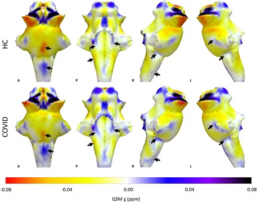 Brainstem Damage Linked to Severe COVID-19 Symptoms, New Study Reveals